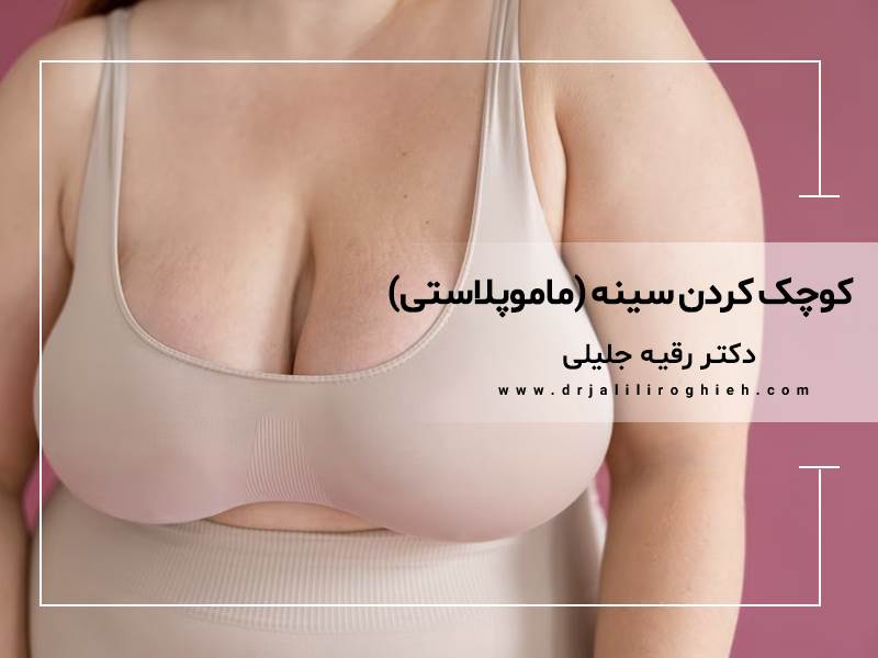 جراحی کوچک کردن سینه در تهران ( ماموپلاستی کاهشی)